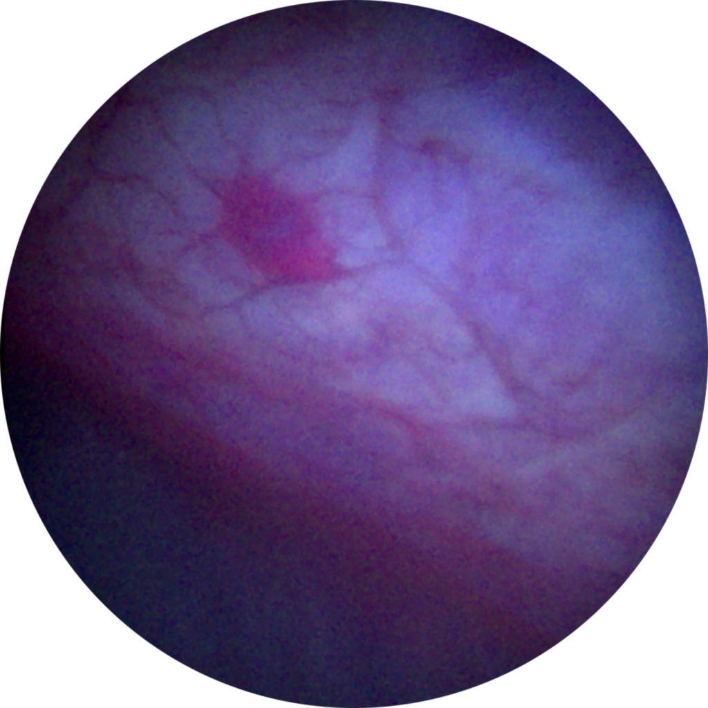 About Cysview – French – CYSVIEW